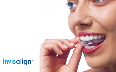 Invisalign® – A tökéletes mosoly láthatatlan fogszabályozással