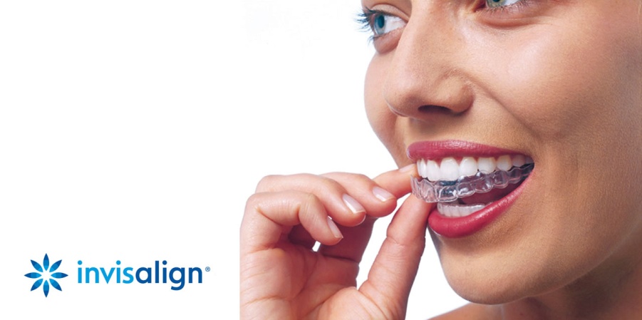 Invisalign® – A tökéletes mosoly láthatatlan fogszabályozással